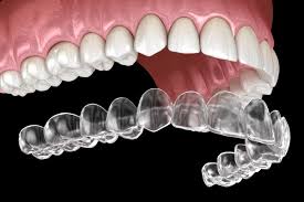 Orthodontics (Invasalign)
